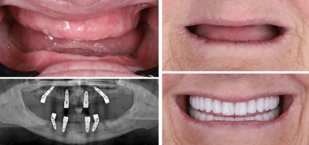 all on 4 implants in encino ca