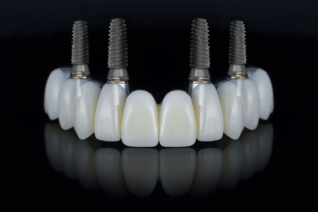 all on 4 implants near you