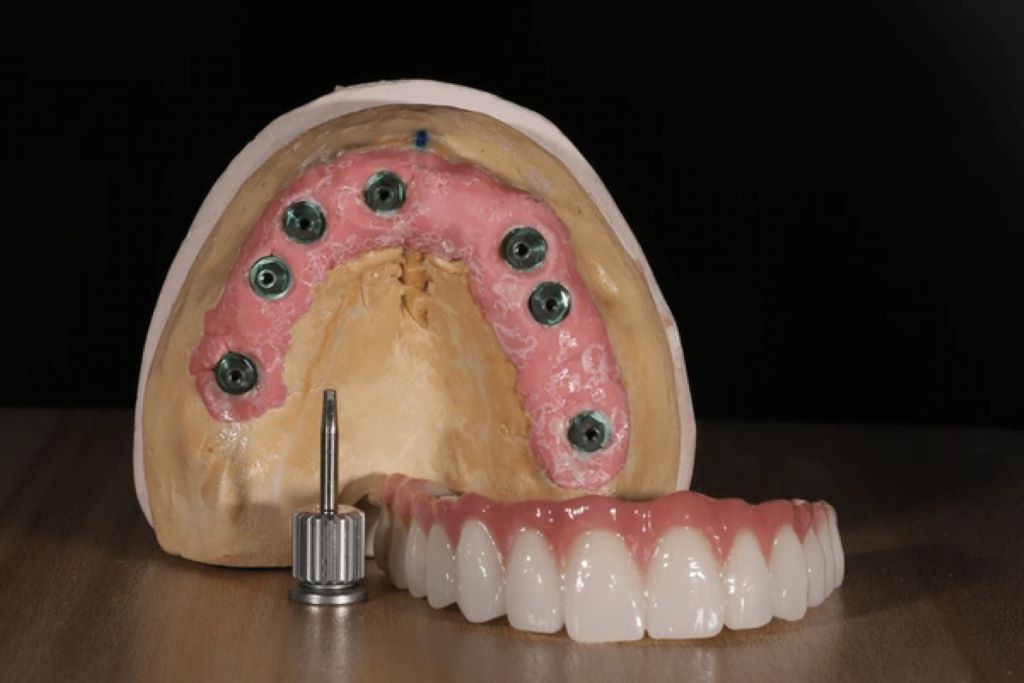 bone grafting in encino ca