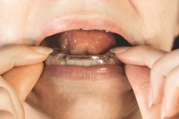 bruxism treatment in encino ca