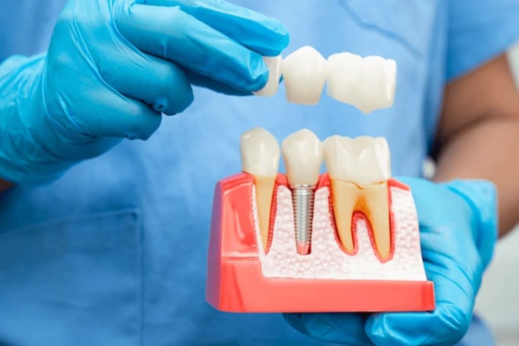 dental implants near you