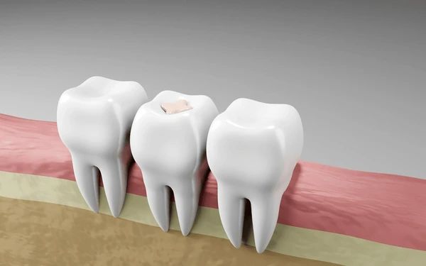 dental onlays & inlays in encino ca