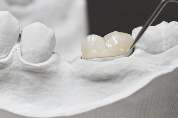 dental onlays & inlays near you