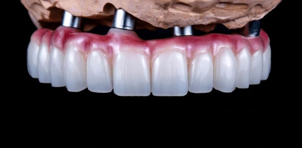 full mouth reconstructions in encino ca