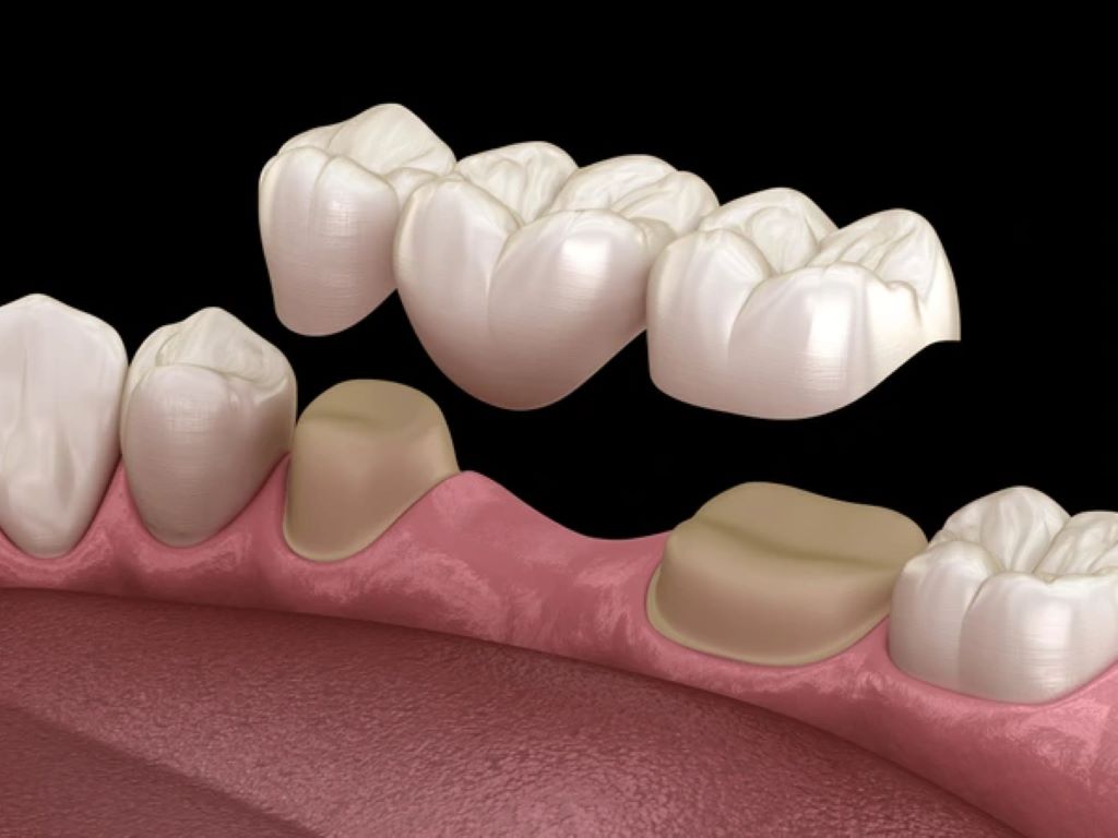 porcelain bridges in encino ca