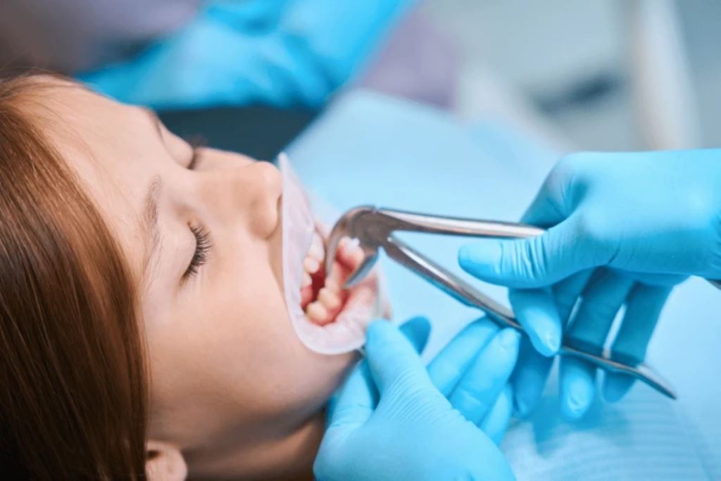 tooth extractions in encino ca