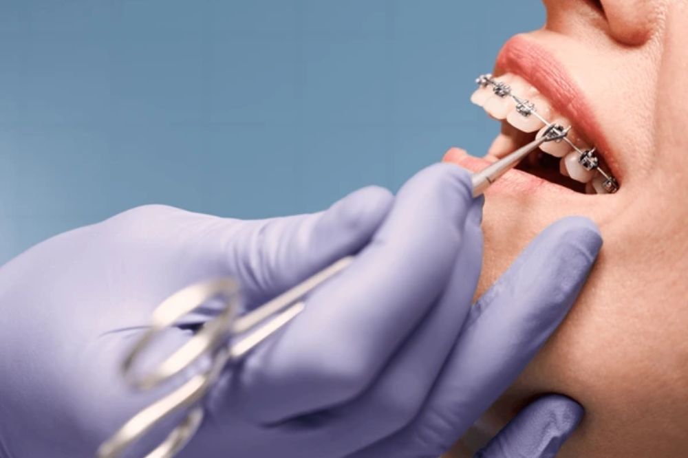 why orthodontic treatment can improve more than just your smile